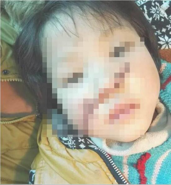 10岁女孩模仿光头强 用电锯锯开妹妹鼻子